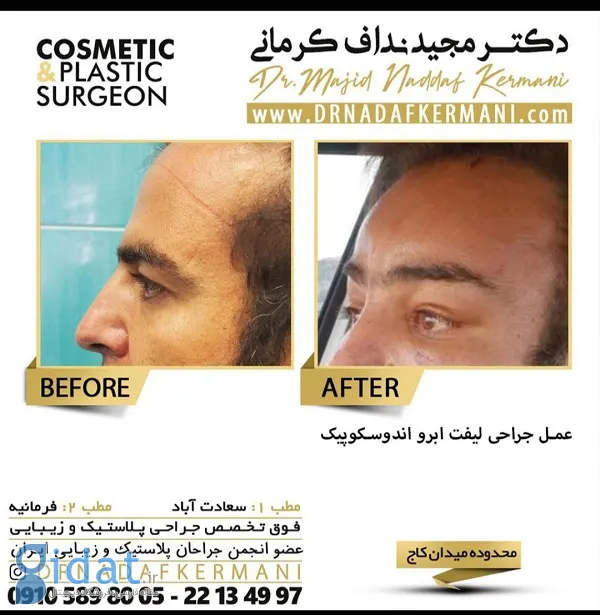 لیفت ﺍبرو چیست و با چه روش هایی انجام می‌شود؟